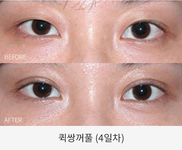 퀵쌍꺼풀
