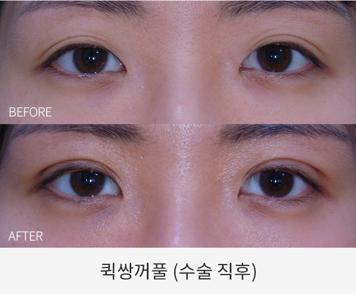 퀵쌍꺼풀