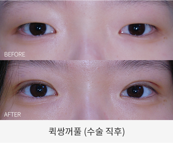 퀵쌍꺼풀