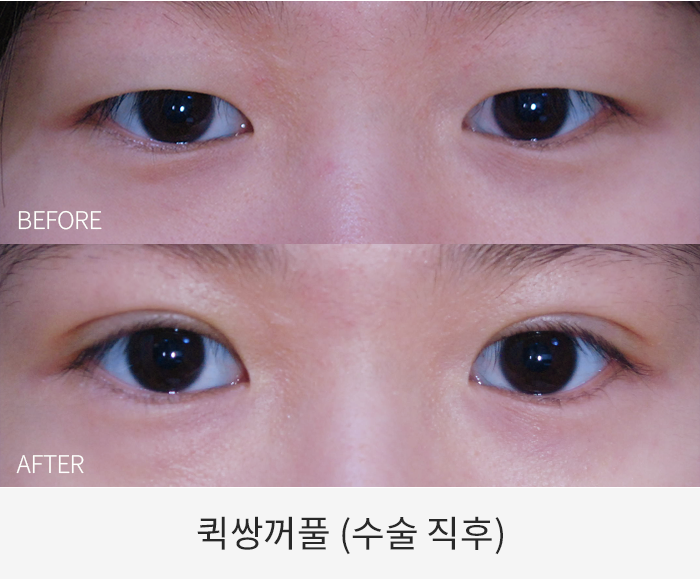 퀵쌍꺼풀