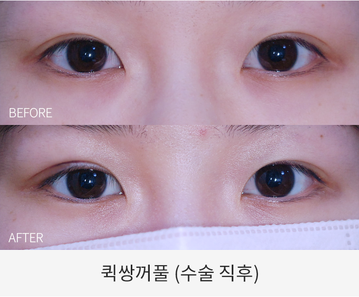 퀵쌍꺼풀