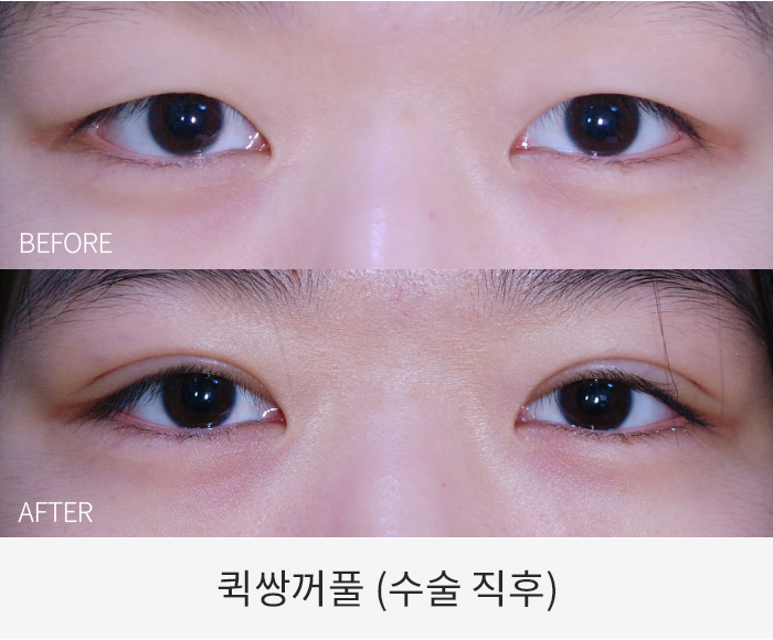 퀵쌍꺼풀