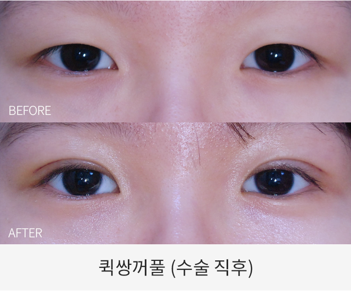 퀵쌍꺼풀