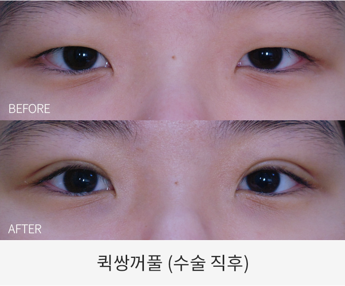 퀵쌍꺼풀