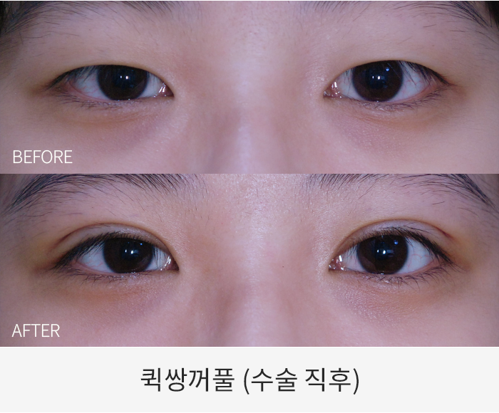 퀵쌍꺼풀