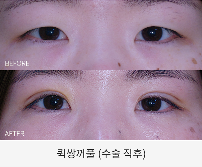 퀵쌍꺼풀