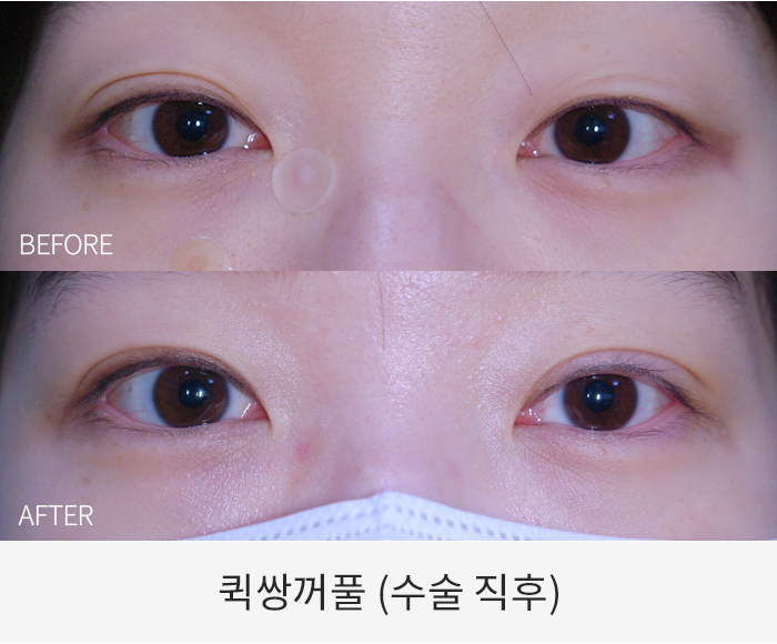 퀵쌍꺼풀