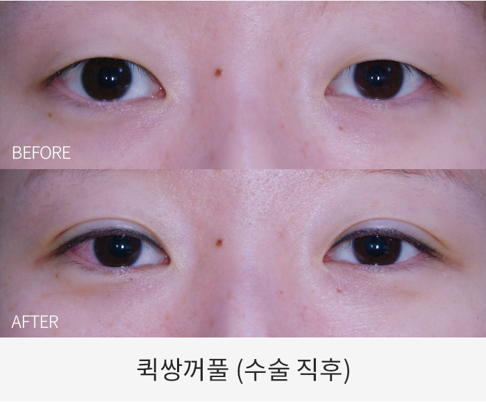 퀵쌍꺼풀