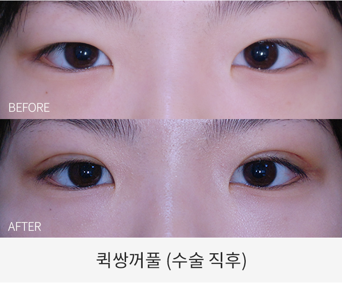 퀵쌍꺼풀
