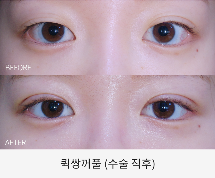 퀵쌍꺼풀