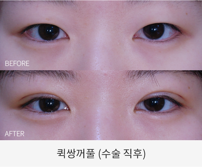 퀵쌍꺼풀