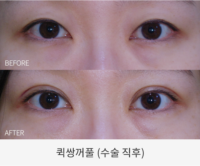 퀵쌍꺼풀