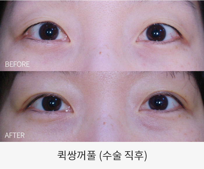 퀵쌍꺼풀