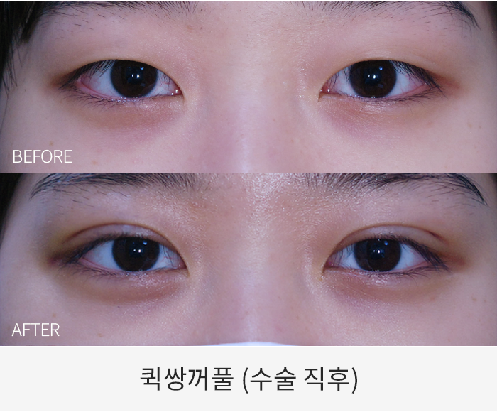 퀵쌍꺼풀