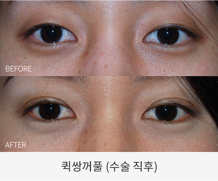 퀵쌍꺼풀
