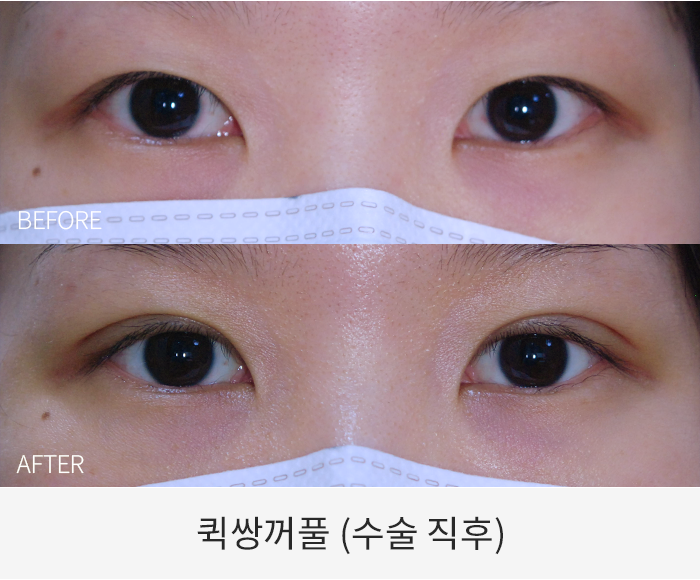 퀵쌍꺼풀
