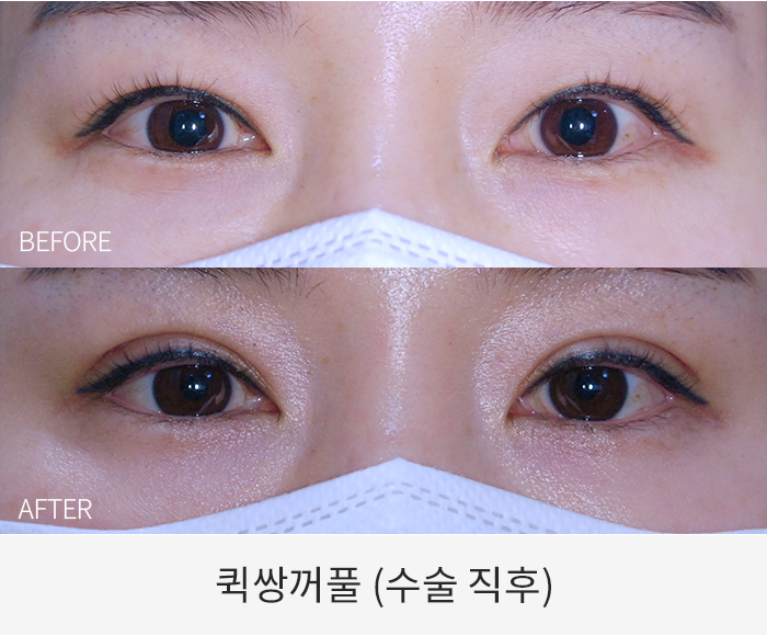 퀵쌍꺼풀