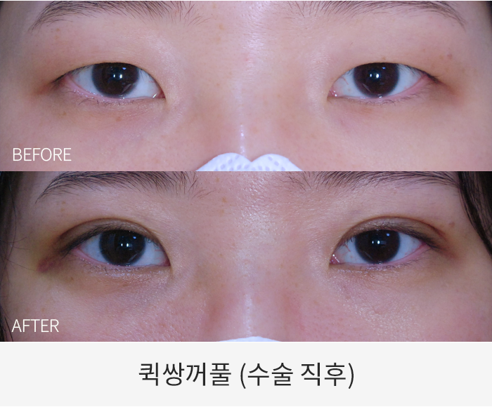 퀵쌍꺼풀