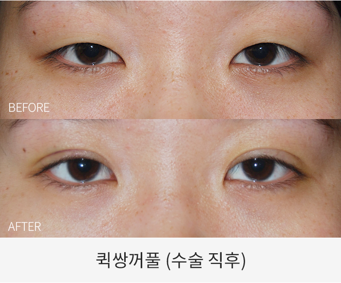 퀵쌍꺼풀