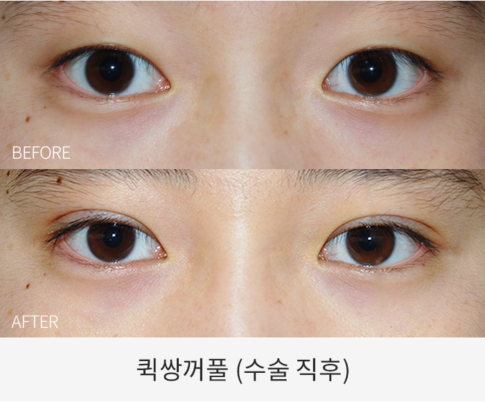 퀵쌍꺼풀