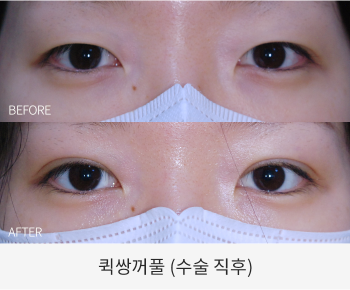 퀵쌍꺼풀