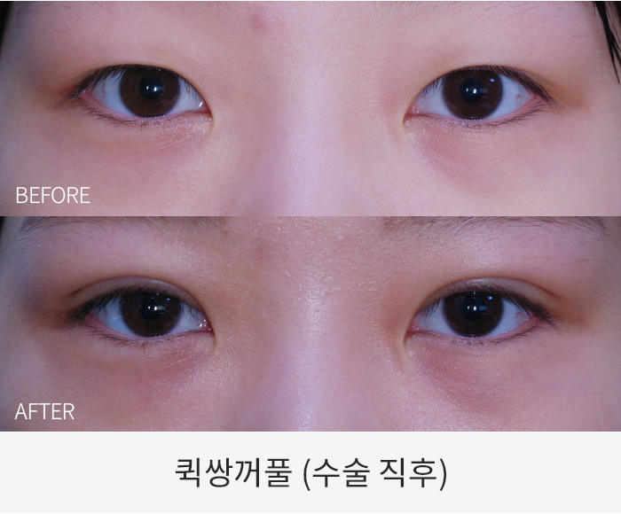 퀵쌍꺼풀