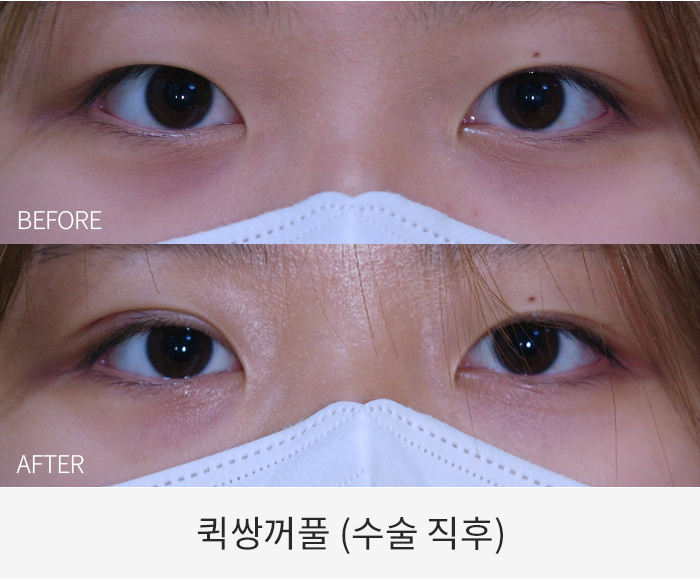 퀵쌍꺼풀