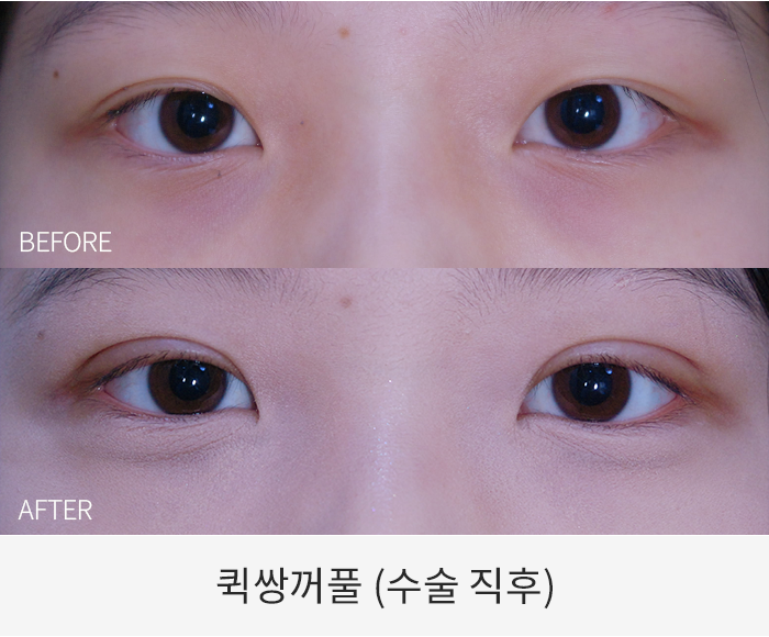 퀵쌍꺼풀