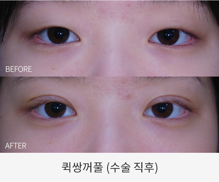 퀵쌍꺼풀