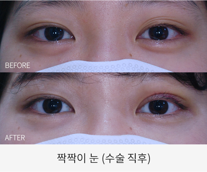 짝짝이눈