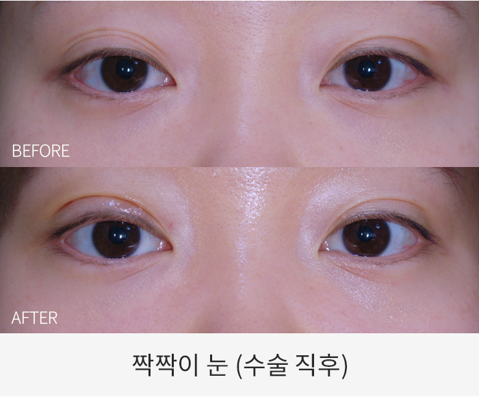 짝짝이눈