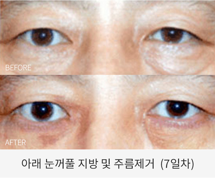 아래 눈꺼풀 지방 및 주름제거