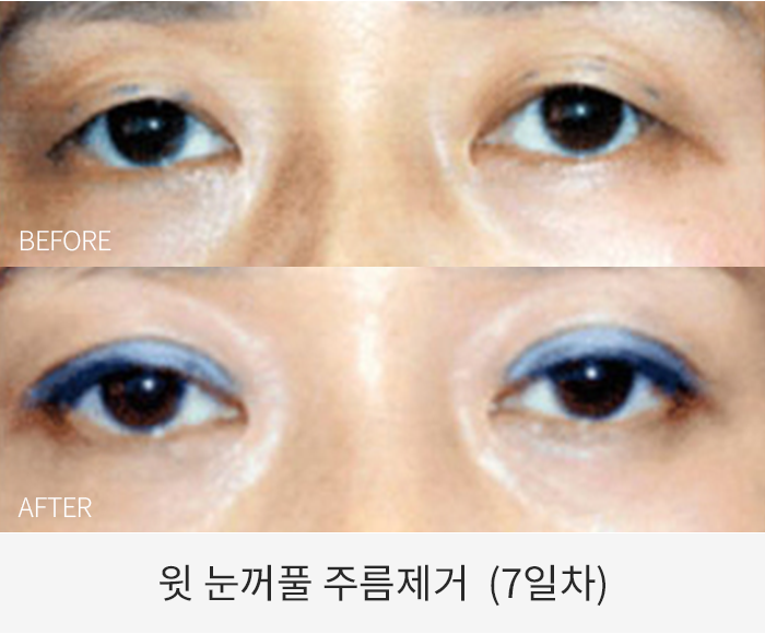 윗 눈꺼풀 주름제거