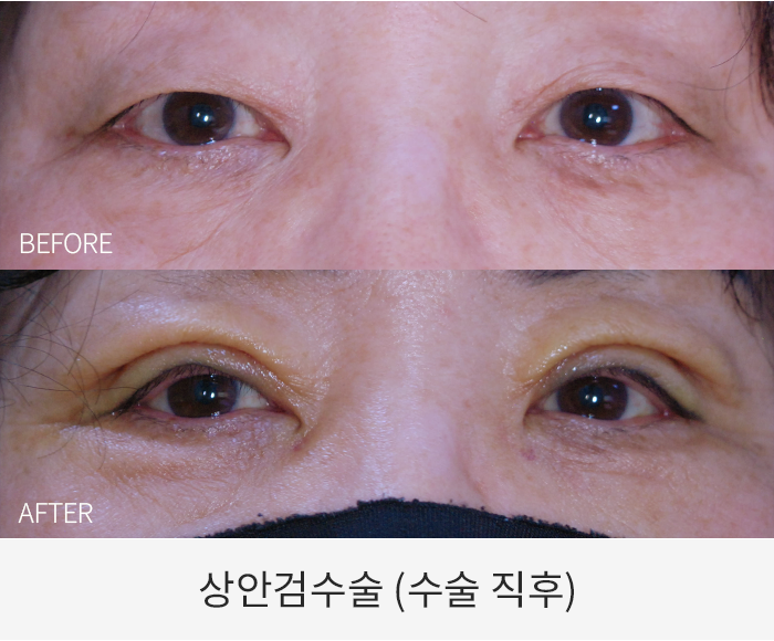 상안검