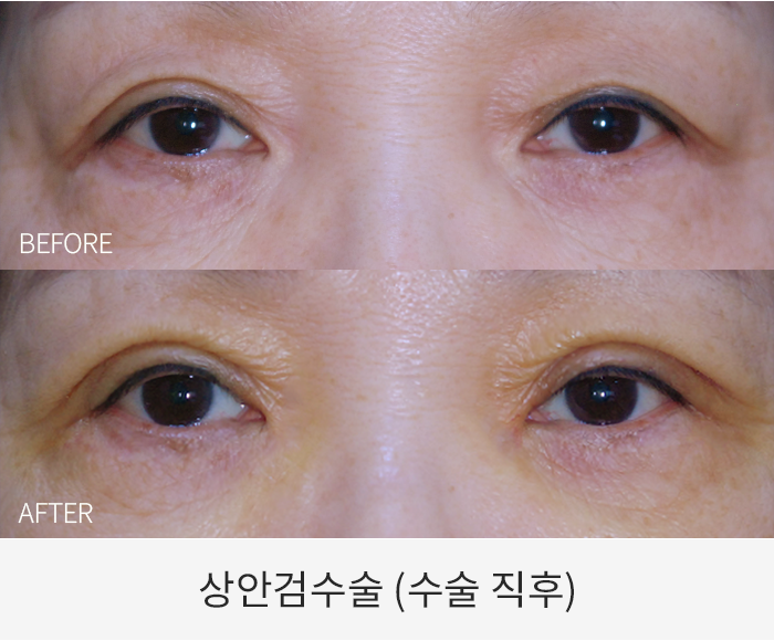 상안검