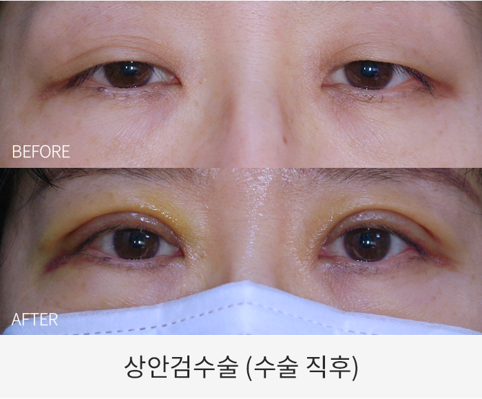 상안검