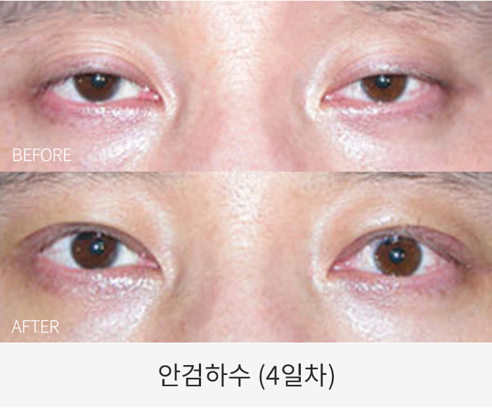 안검하수