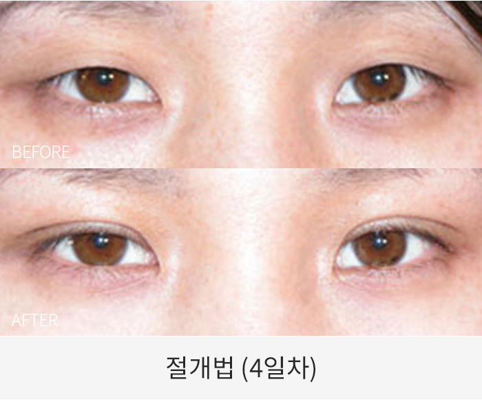 절개법