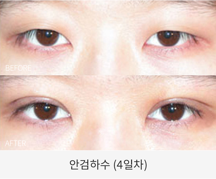 안검하수