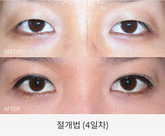절개법