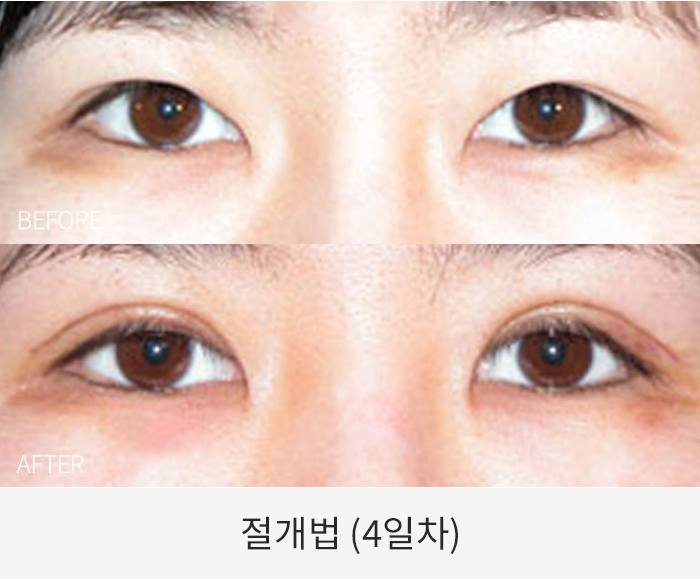절개법