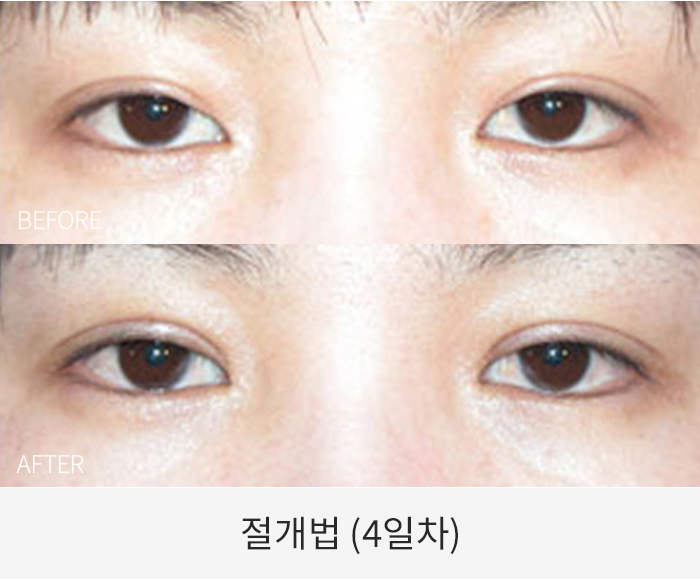 절개법