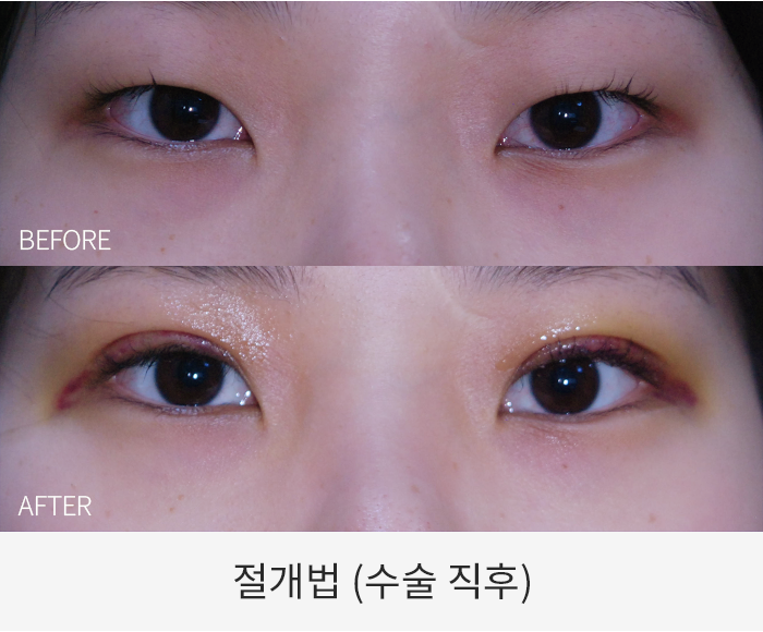 절개법