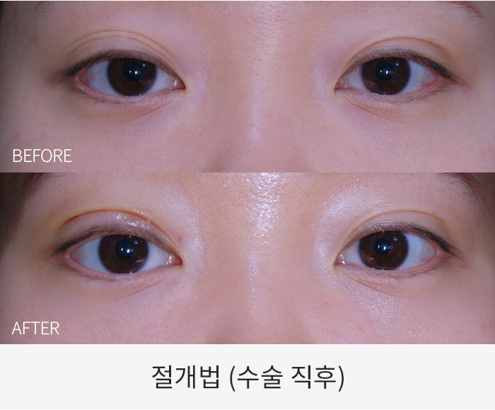 절개법