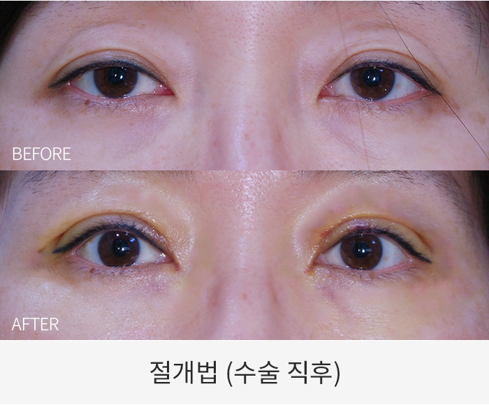 절개법