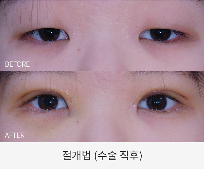절개법