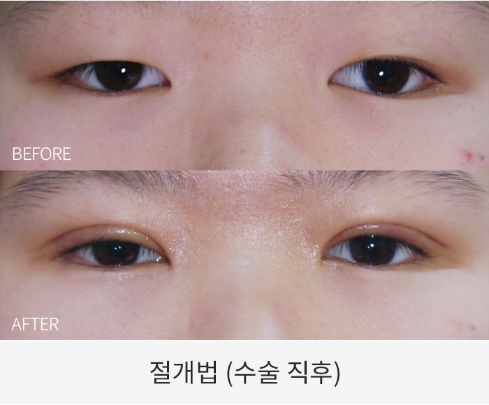 절개법