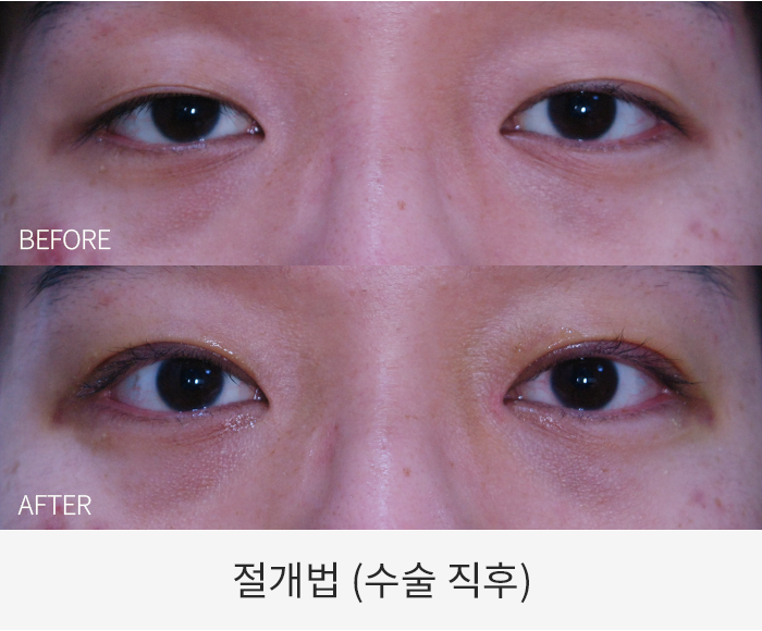 절개법