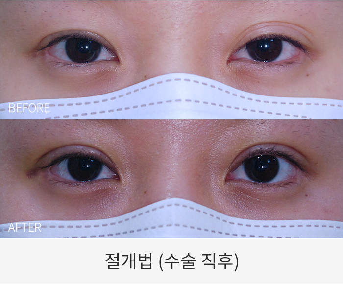 절개법