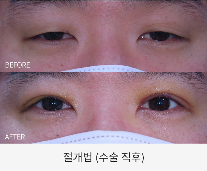 절개법